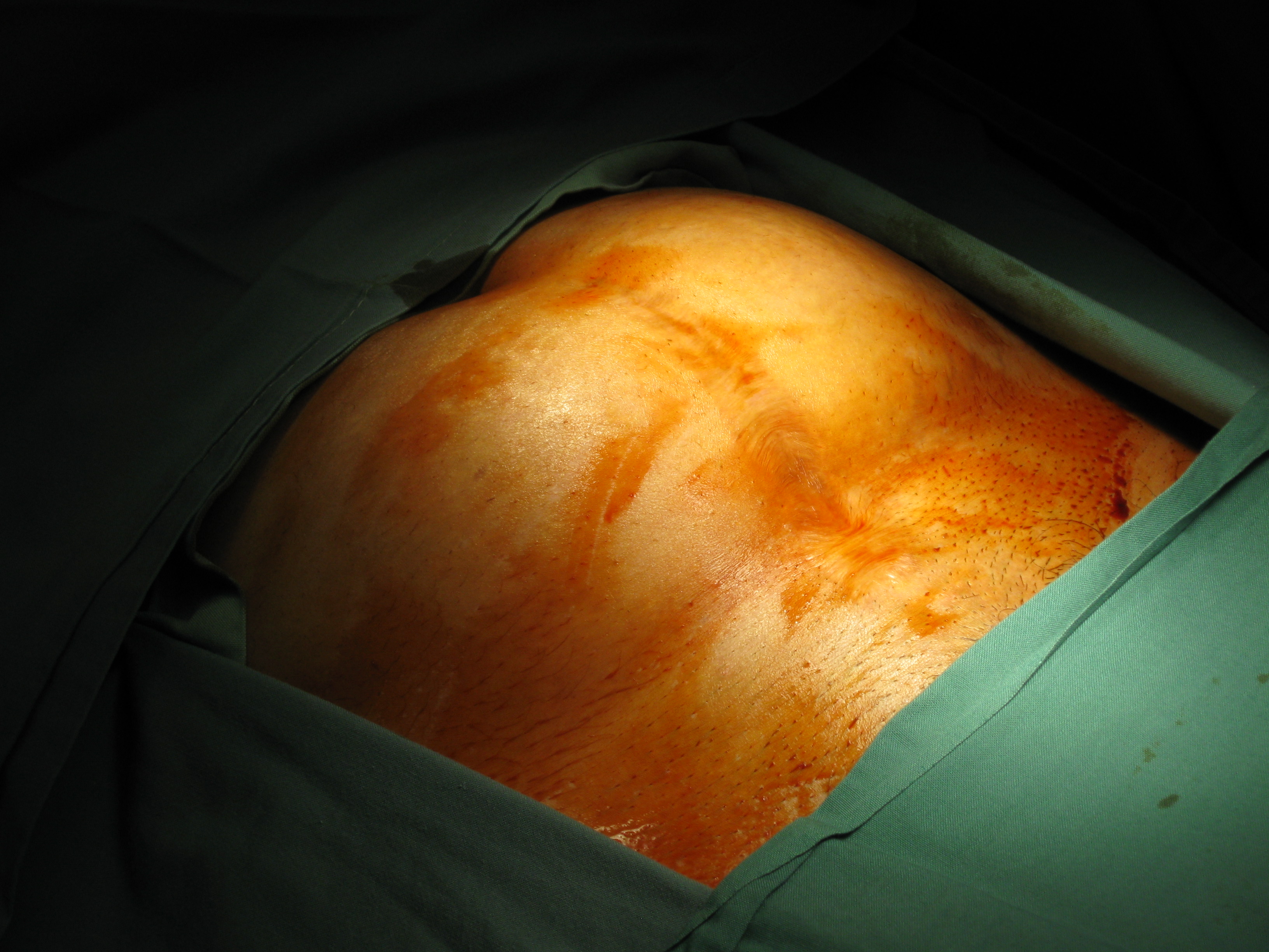 Fibroid Abdominal Myomectomy Serag Youssif
